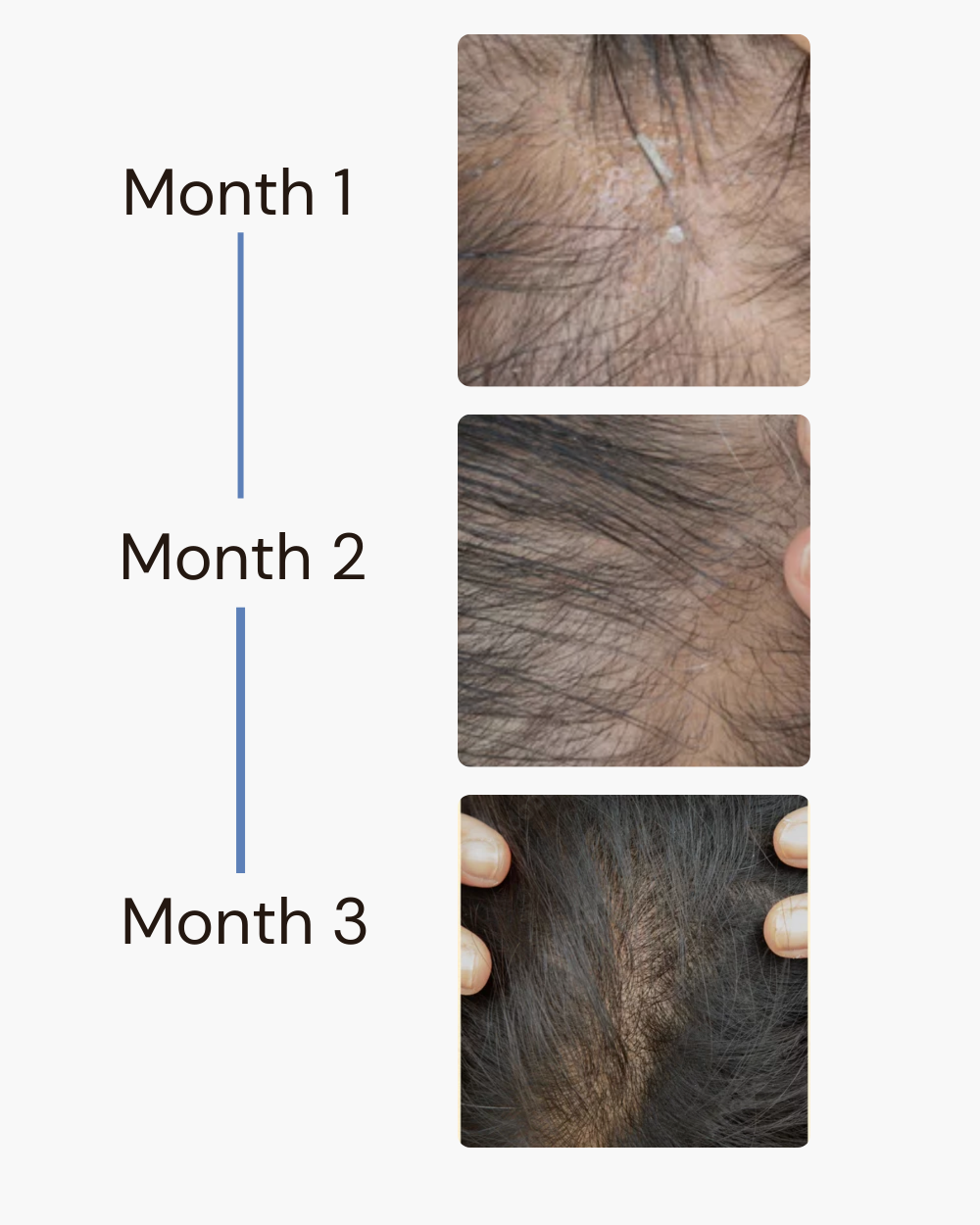 Finasteride 1mg (30 Tablets)